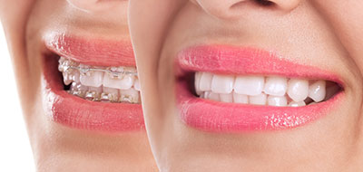 Alta Dental | Protector Bucal, Implantes and Puentes de Porcelana