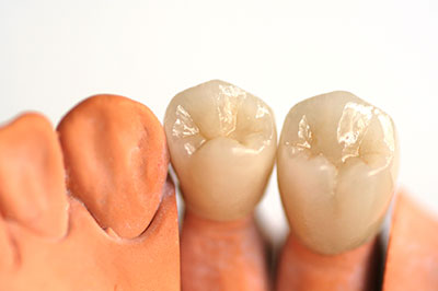Alta Dental | Terapia Periodontal o Limpiezas Profundas, Rellenos Blancos and Dentaduras Retenidas por Implantes