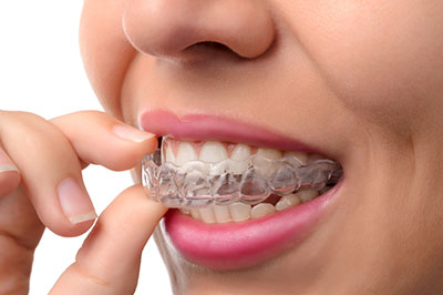 Alta Dental | Implantes, Sellantes y Servicios Preventivos and Invisalign reg 